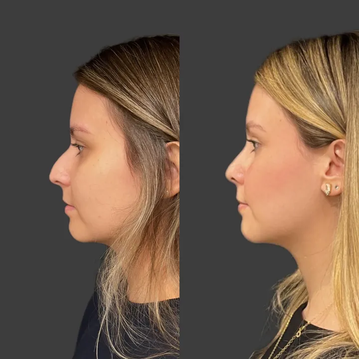 Antes e depois de rinoplastia, foto 1
