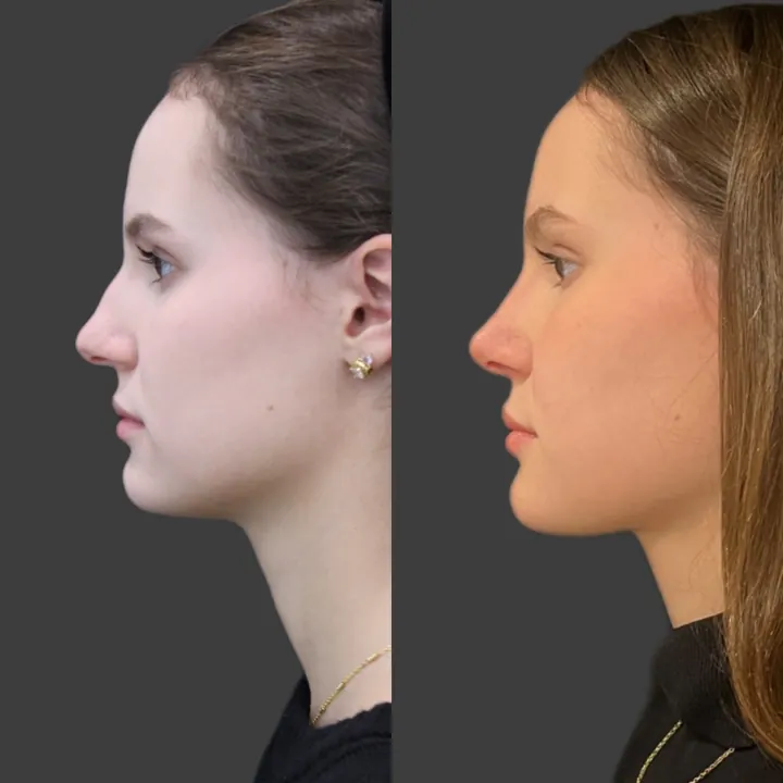 Antes e depois de rinoplastia, foto 2