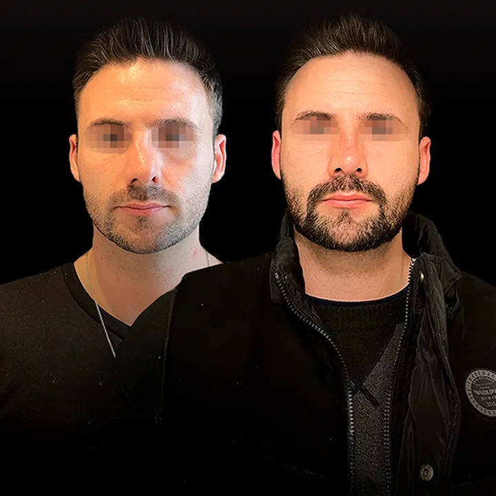 Antes e depois de rinoplastia, foto 3