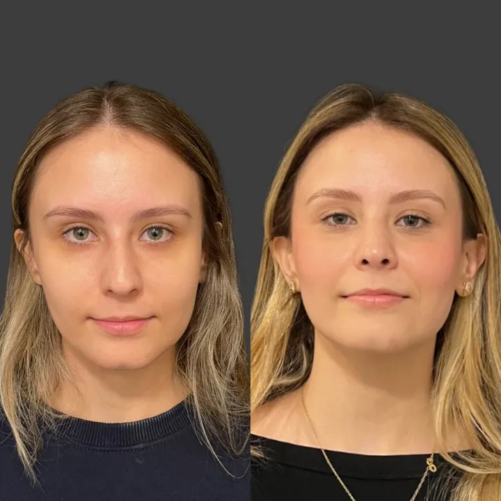 Antes e depois de rinoplastia, foto 4