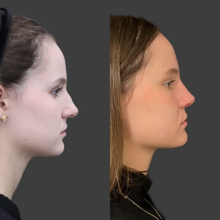 Antes e depois de rinoplastia, foto 5