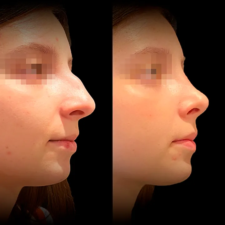 Antes e depois de rinoplastia, foto 6