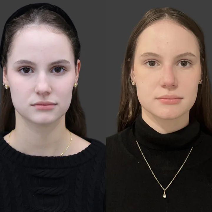Antes e depois de rinoplastia, foto 8
