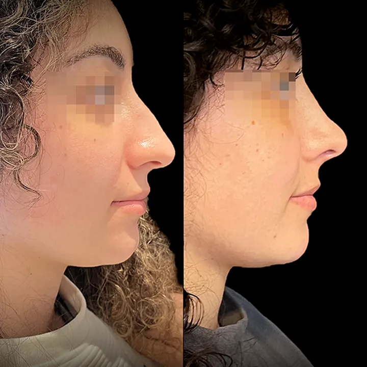 Antes e depois de rinoplastia, foto 9