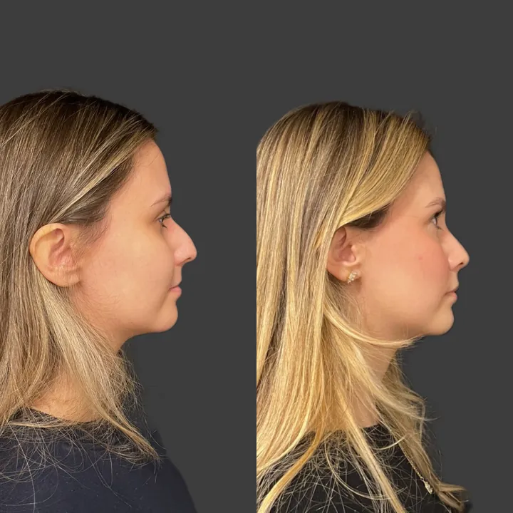Antes e depois de rinoplastia, foto 10