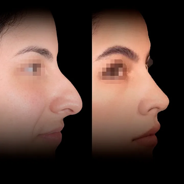Antes e depois de rinoplastia, foto 12