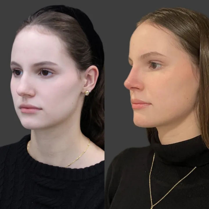 Antes e depois de rinoplastia, foto 13