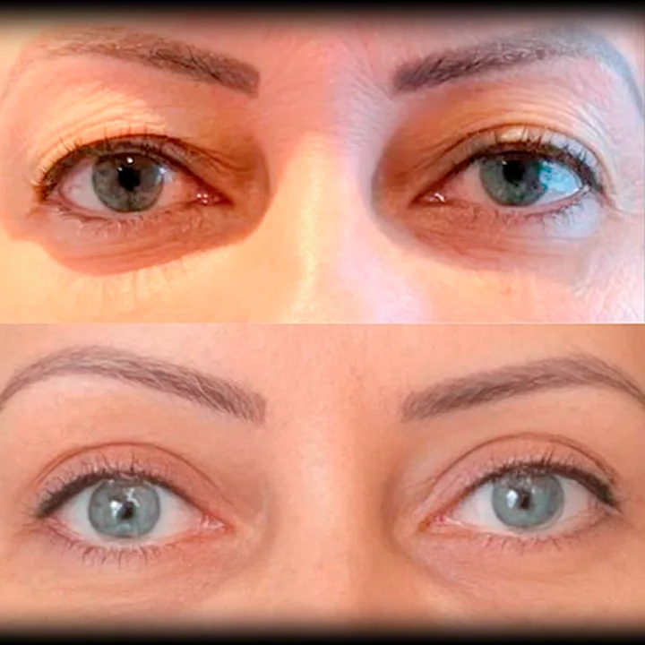 Antes e depois de blefaroplastia